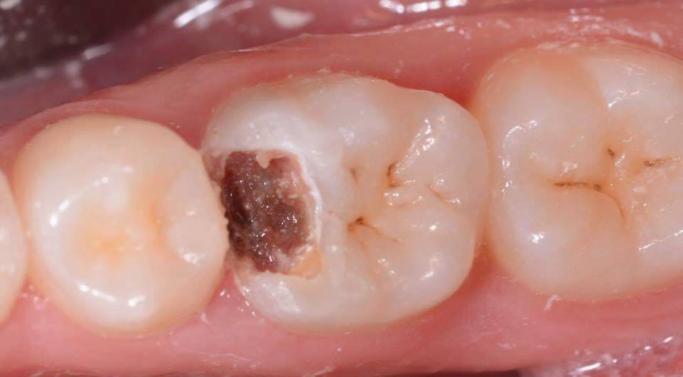  zub poškozený kazem 