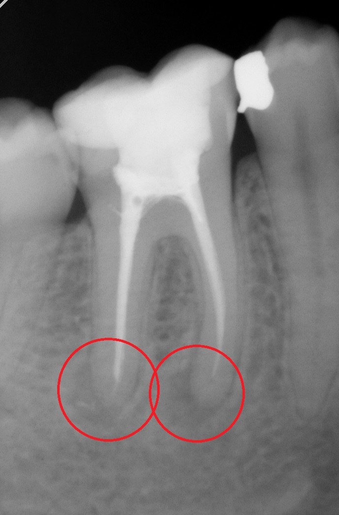 Zub s nedoplněnými kanálky a zánětem pod kořeny
