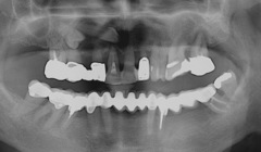 Pacientka se přestěhovala před definitivní prací v horní čelisti. V HČ dle OPG dva retinované zuby. Po konzultaci s chirurgem bylo doporučeno tyto zuby před protetikou odstranit.